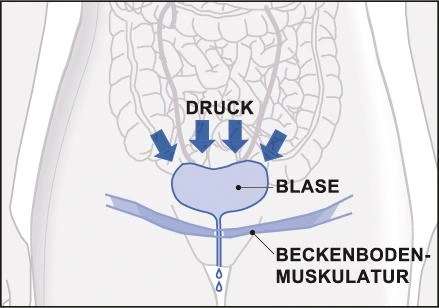 Harninkontinenz der Beckenbodenmuskulatur